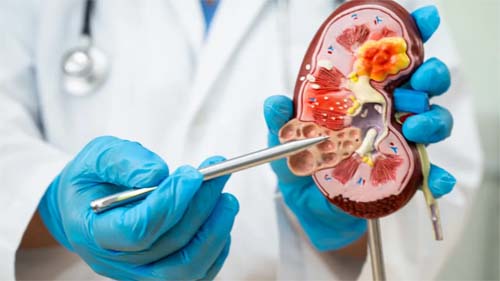 Aumento de casos de cálculos renais no verão: causas e prevenção