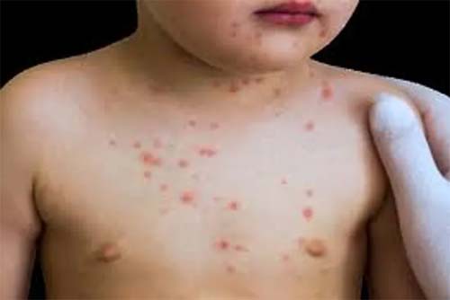 Alagoas registra quarta morte por meningite em 2025; 12 casos confirmados no estado