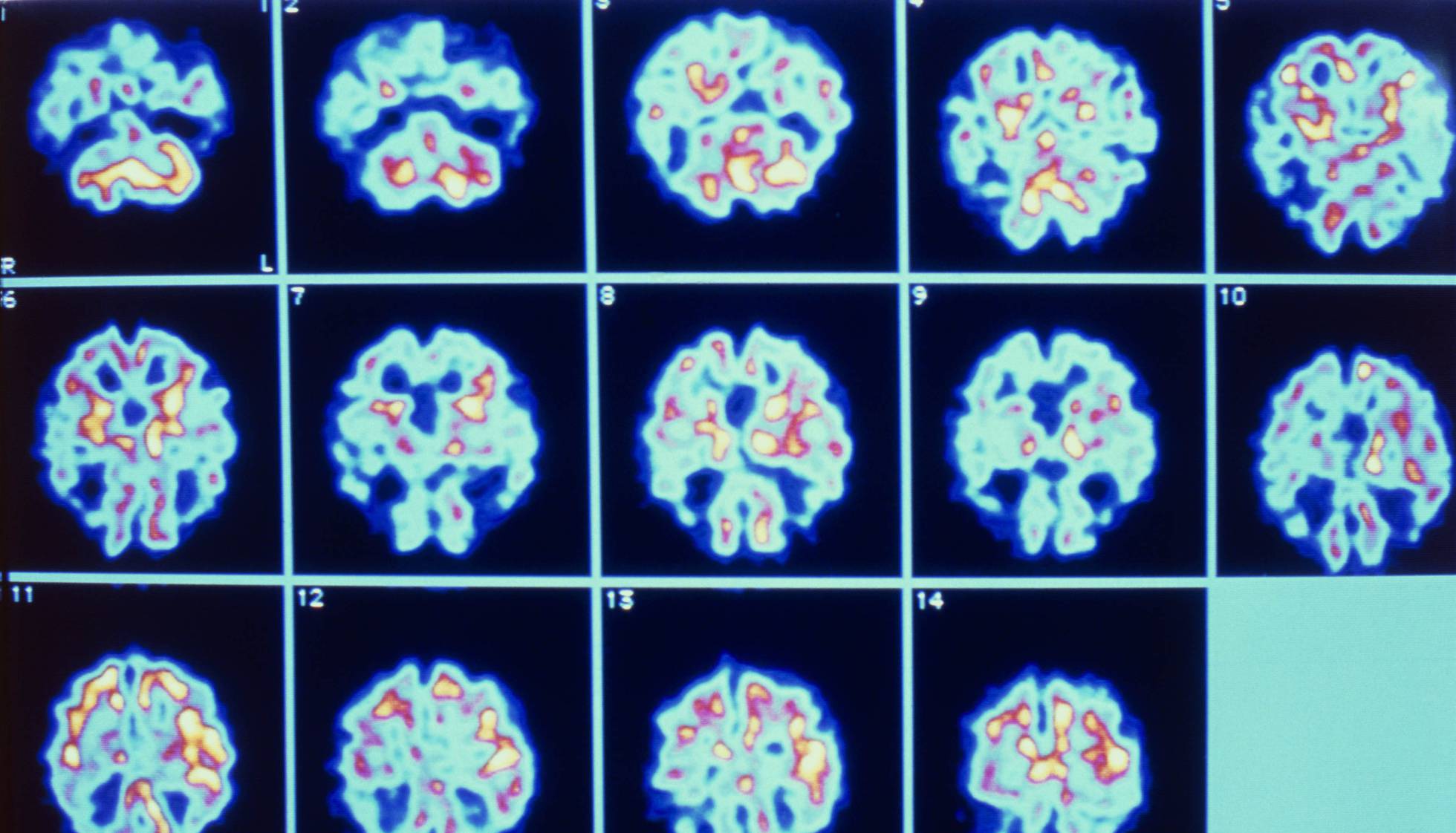 Desafios na busca de um tratamento efetivo contra o Alzheimer