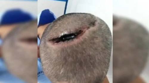 Paciente é intubado com Covid-19 e acorda com cabeça rachada; imagens são fortes