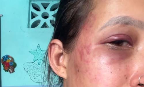 Mulher denuncia agressões do companheiro nas redes sociais após se recusar a manter relação sexual