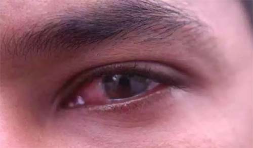 Conjuntivite pode ser sintoma de casos graves da covid-19, diz estudo