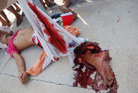 Jovem tem pé decepado em grave acidente de moto na AL-101 Sul em Massagueira