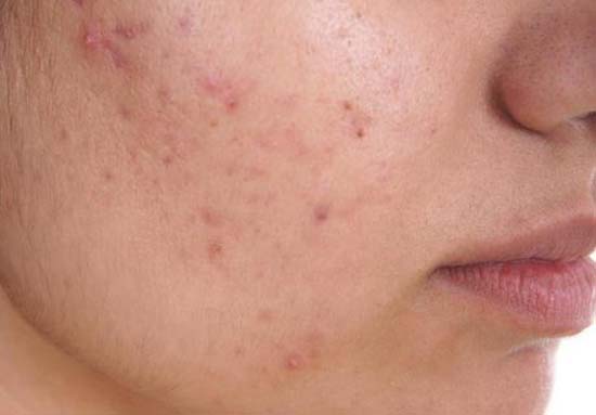 Pesquisadores estão desenvolvendo vacina contra acnes