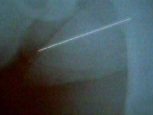 Menina de dois anos aguarda cirurgia para retirar agulhas do corpo em AL