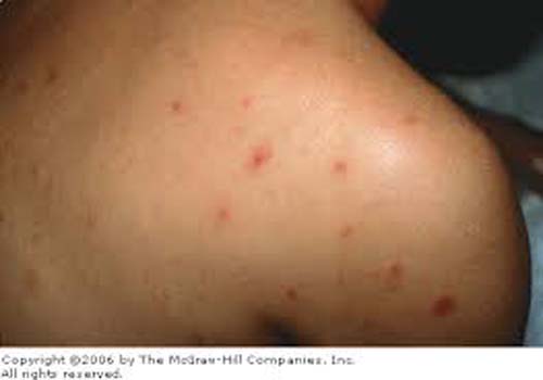 Aumenta o número de jovens infectados pelo vírus da Aids