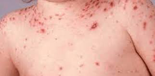 Secretaria de Saúde confirma 1º caso de sarampo em Alagoas em 19 anos