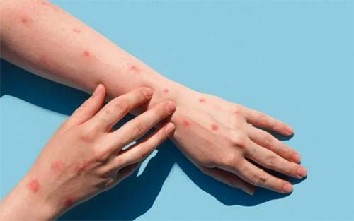 Alagoas confirma terceiro caso de varíola dos macacos