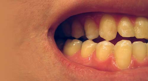 Alinhadores invisíveis e flexíveis são os mais modernos na correção dos dentes