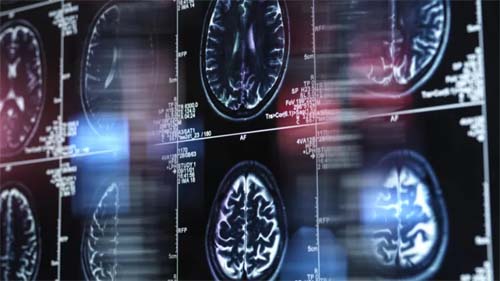 Chinês de 19 anos pode ser pessoa mais jovem com Alzheimer e causa é mistério para cientistas