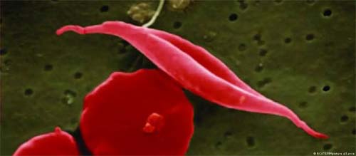 Terapia genética vence doença sanguínea hereditária