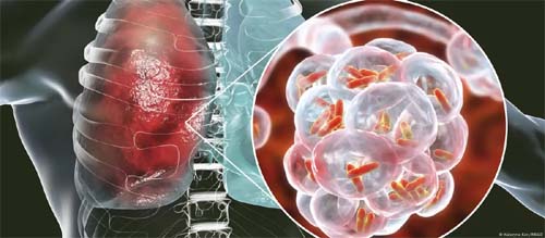 Surto de bactéria legionela preocupa moradores de Berlim