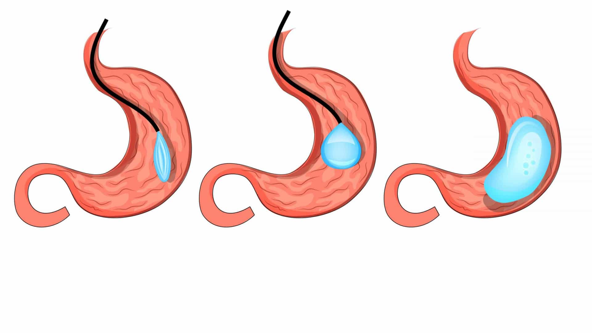 Obesidade: 10 dúvidas sobre balão intragástrico
