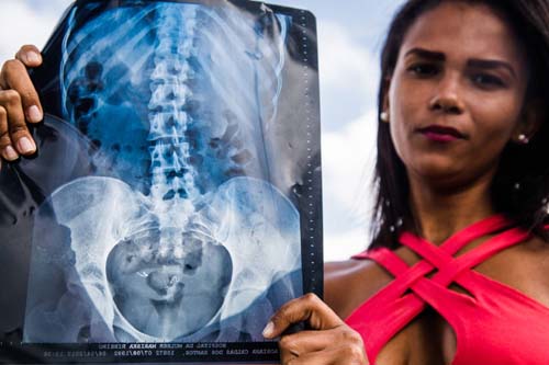 As vítimas de um implante da Bayer que prometia esterilizar mulheres