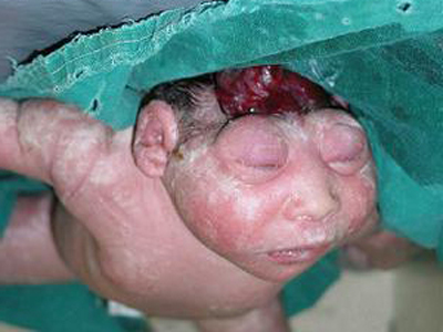 Em julgamento histórico, STF legaliza aborto de feto anencefálico