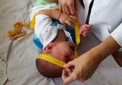 Mães de bebês com microcefalia vivem novos desafios
