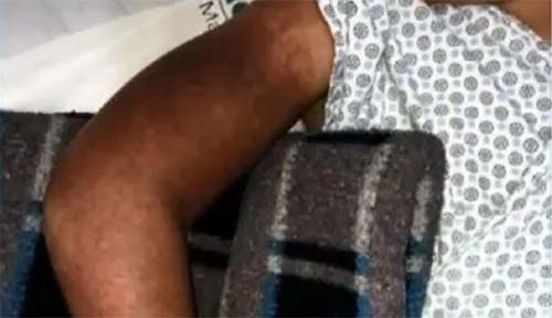 Criança de 10 anos tem braço sugado por ralo de piscina em Maceió