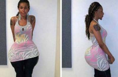 Falso médico injeta cola e cimento para crecer bumbum de paciente