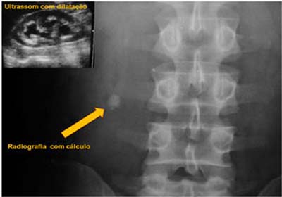 Cálculo renal é mais frequente no verão