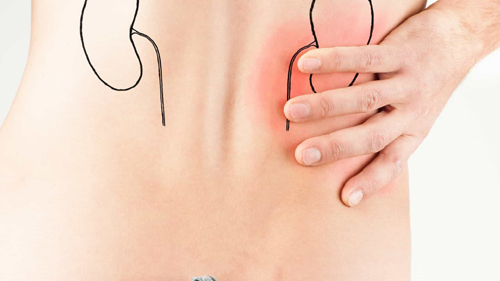 Pedra nos rins: como prevenir?