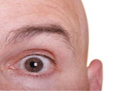 Calvície: como prevenir ou solucionar