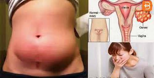 Temos as armas contra o câncer cervical, mas elas não chegam para todas