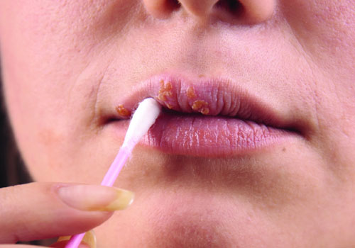 Sete em cada dez pacientes com câncer de boca começam tratamento com doença em estágio avançado