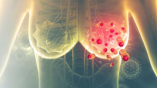 AstraZeneca anuncia medicamento promissor contra câncer de mama