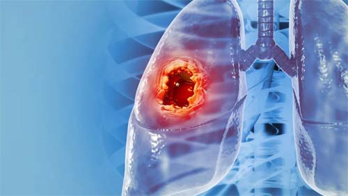 Mudança de hábitos pode prevenir dez tipos de câncer, afirma especialista