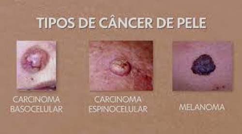 Prevenção e Cuidados diante do Câncer de Pele Diagnosticado em Bolsonaro