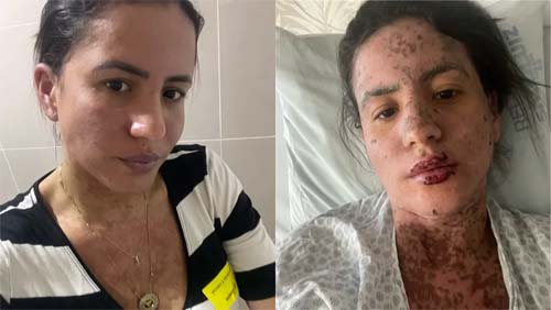 Stevens-Johnson: entenda qual é a doença de pele rara que deixou a mulher de Frank Aguiar na UTI
