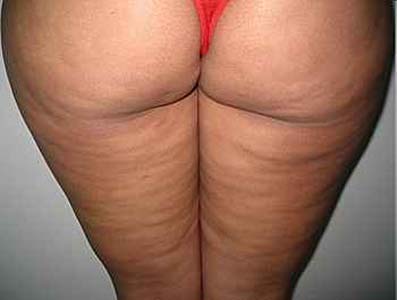 Conheça os alimentos que ajudam na prevenção e no combate à celulite