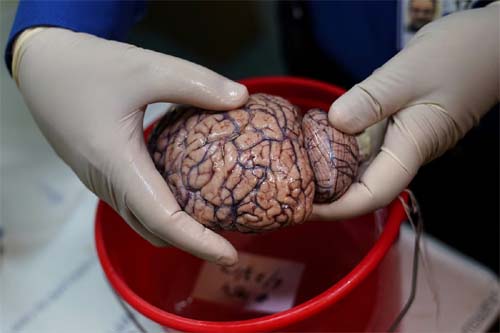 Descoberta do papel essencial do lítio no Alzheimer abre caminho promissor para tratamento da doença