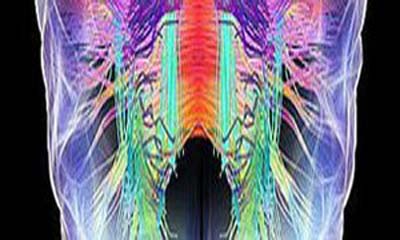 Derrames podem ser prevenidos com remédios combinados, sugere estudo