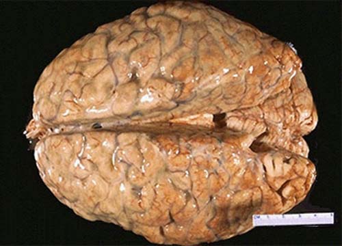 Morte de garoto com 10 anos com sintomas de meningite gera especulações da comunidade de União dos Palmares