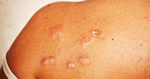 Predisposições genéticas podem favorecer o desenvolvimento do queloide