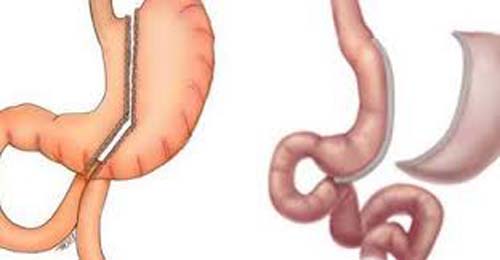 Número de cirurgias bariátricas aumenta 84,73% em sete anos