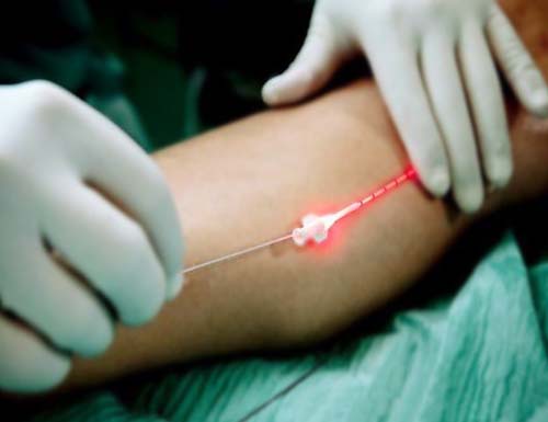 Endoleser para cirurgia de varizes: Alagoas já tem profissionais habilitados para o tratamento