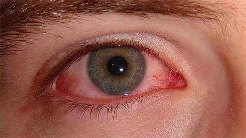 Gripe e resfriado impulsionam aumento de casos de conjuntivite durante o frio
