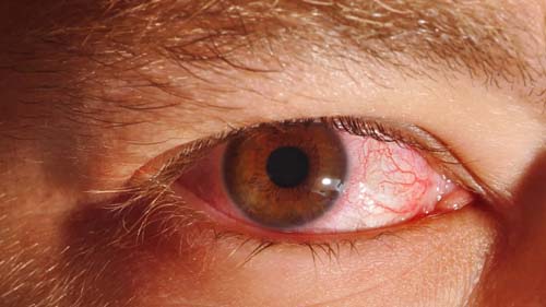 Primavera contribui para aumento de casos de conjuntivite alérgica