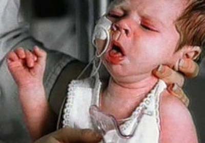 Aumento no número de casos de coqueluche deixa a população em alerta 