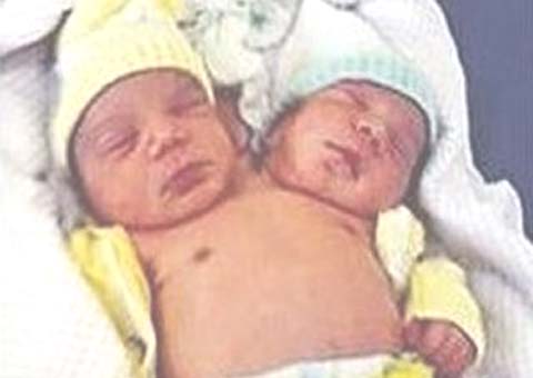 Jovem de 23 anos dá à luz criança que nasceu com duas cabeças
