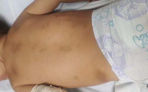 Criança de um ano e dez meses é espancada pela mãe em São José da Laje