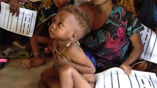 Relatório da Unicef revela que cerca de 180 milhões de crianças sofrem de pobreza alimentar severa no mundo