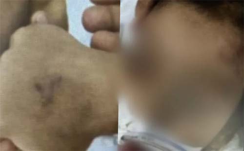 Criança de apenas 5 anos é intubada após ser espancada
