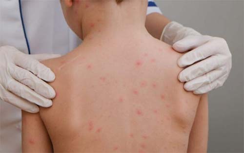 Aluno de escola particular é diagnosticado com meningite em Maceió