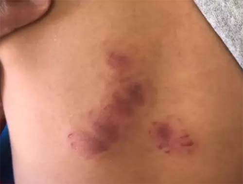 Professoras de creche onde criança foi mordida 19 vezes são indiciadas por omissão e lesão corporal