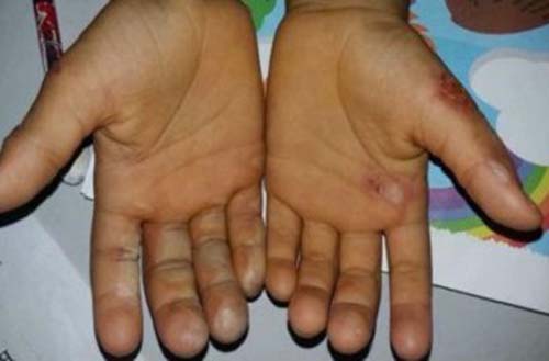 Menina de 12 anos foge de casa e relata tortura, queimadura e espancamento por padrasto e mãe