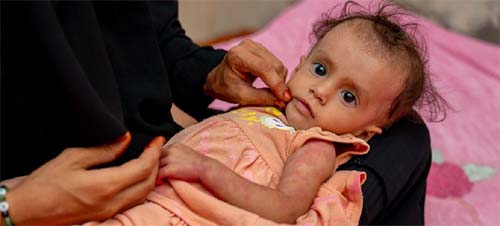 Iêmen tem meio milhão de crianças gravemente desnutridas devido ao conflito