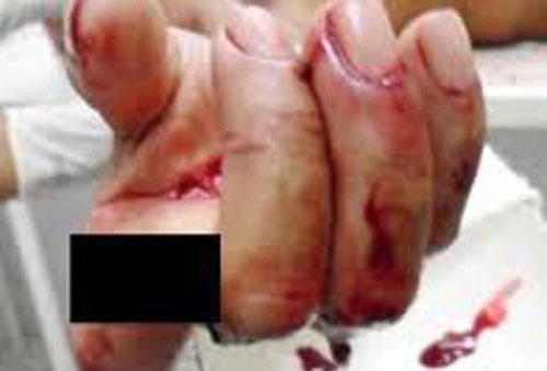 Após briga, marido corta dedo da esposa com facão em Arapiraca